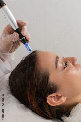 Alopecia. Caucasian girl lies calmly during hair restoration session. Cosmetologist applies dermapen microneedling and injection therapy to stimulate growth and combat hair loss in modern clinic
