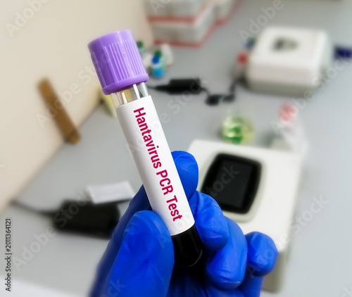 Blood sample for Hantavirus pcr test, Orthohantavirus