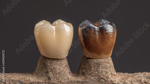 before and after teeth whitening comparison showing yellow stained teeth versus bright white smile