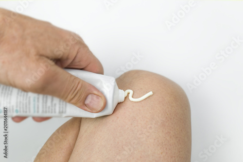 Anti inflammatory gel treatment cream from a tube on a  knee. Treatment of arthrosis and arthritis, anti-inflammatory ointment for the treatment of joints