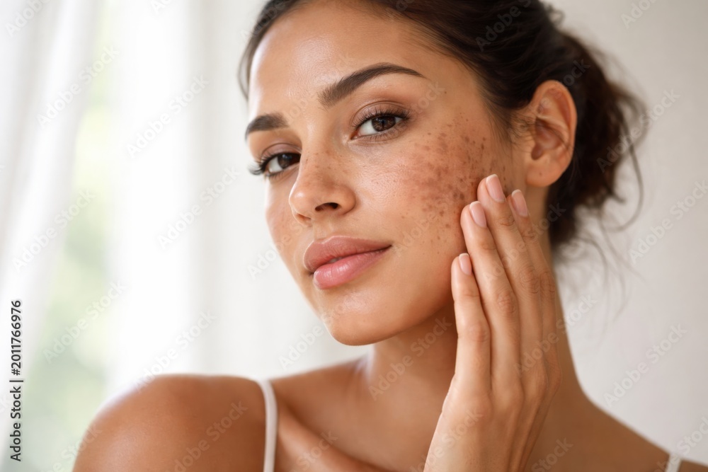 Naklejka premium A close-up of a woman with brown acne scars gently touching her cheek, showcasing natural beauty and skin texture in soft natural light.