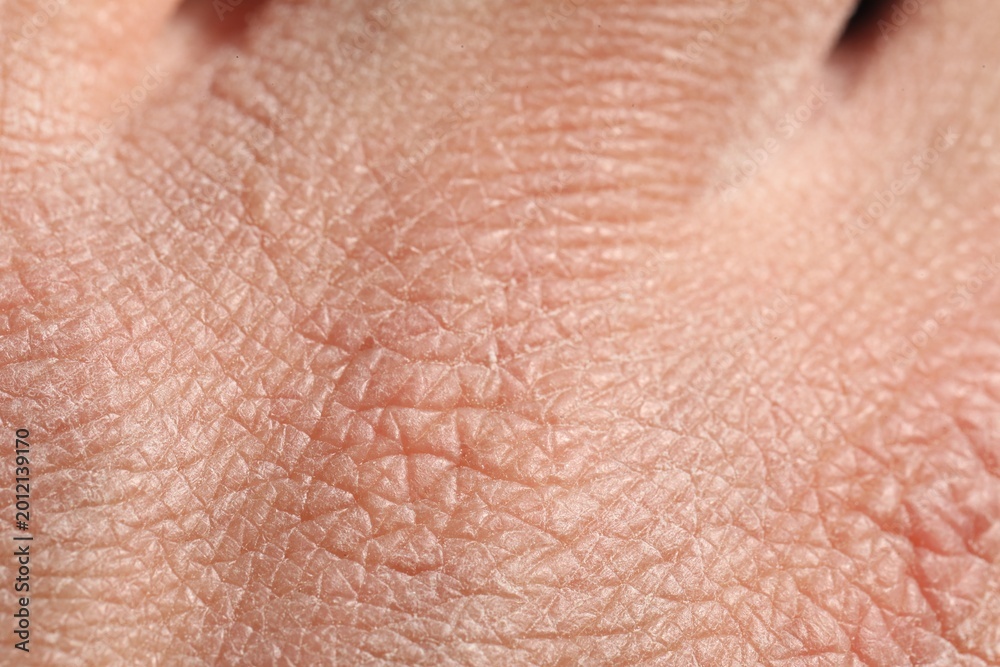 Fototapeta premium Man with dry skin on his hand, closeup