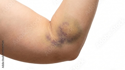 Obraz na płótnie Bruised elbow on human arm with visible skin discoloration