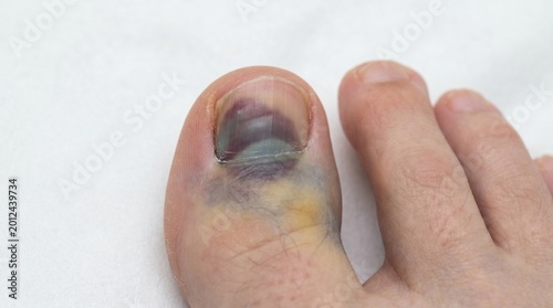 Photos Bruised big toe with discoloration on human foot