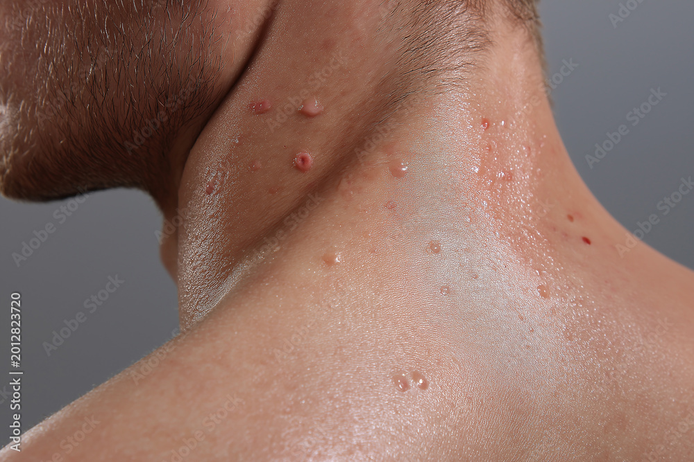 Naklejka premium Oily back skin skin lesion acne pustule neck close up macro texture male body care
