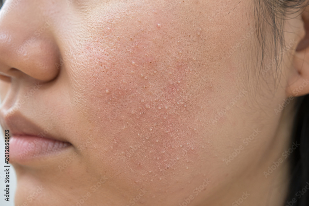 Fototapeta premium Acne on facial skin close-up for practical use