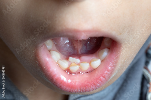 Child mouth showing primary teeth and missing incisor