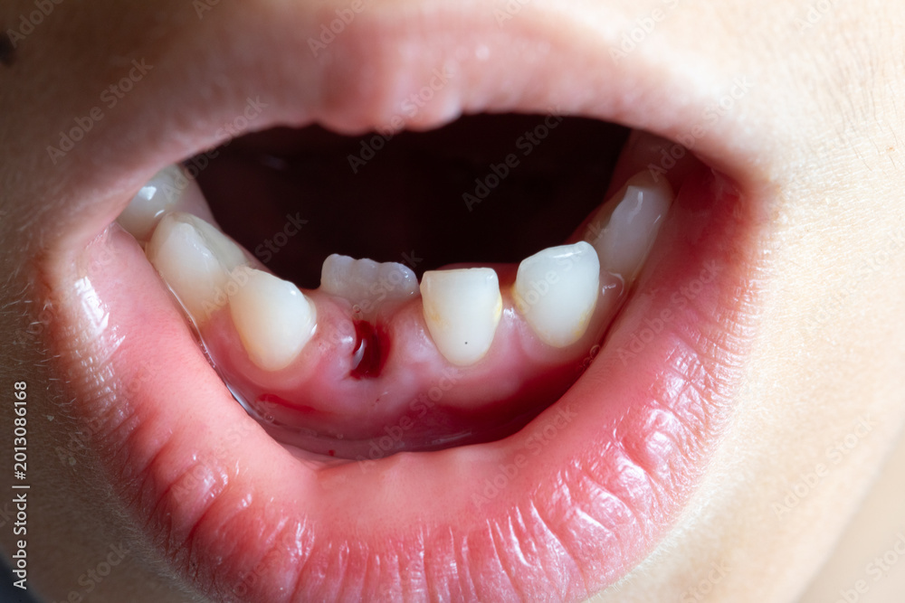 Obraz premium Child mouth showing loss of front deciduous tooth