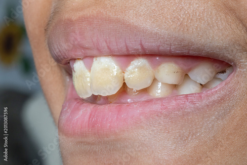 Child's teeth showing dental fluorosis and discoloration