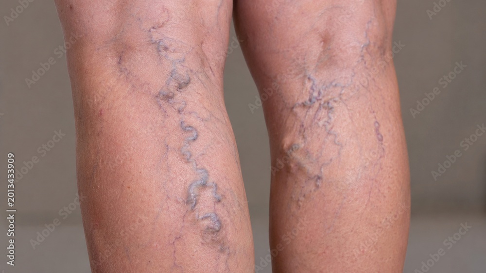 Naklejka premium Ultra-realistic medical visualization showing severe varicose veins with detailed anatomy, cinematic lighting, realistic skin textures, and premium biomedical rendering.