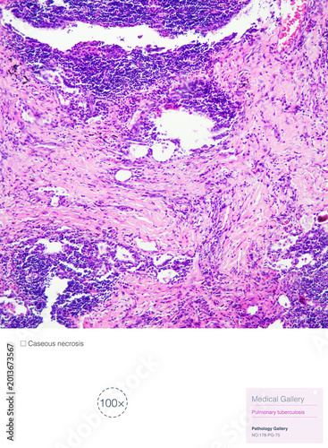 Tuberculosis is a chronic granulomatous inflammation characterized pathologically by tuberculous nodules, which consist of caseous necrosis, epithelioid cells, and macrophages.Magnify 100x.
