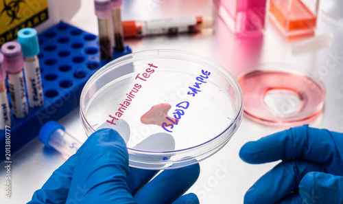 Scientist holding blood sample on a petri dish in a laboratory, study of Hantavirus infection in humans, conceptual image