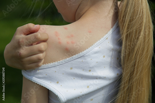Red, swollen and itchy spots on skin caused by insect bites or allergy. Skin reaction to insect bites. 