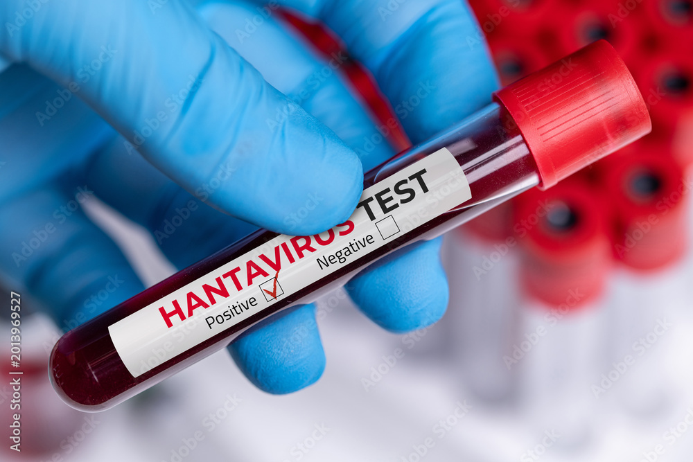 Obraz premium Hantavirus blood test tube in laboratory research and medical analysis setting