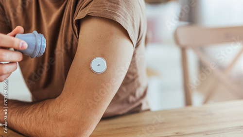 Quadro su tela Young Man Applying Continuous Glucose Monitor Sensor To Upper Arm Managing Diabe