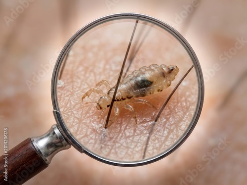 Close-up of a head louse under a magnifying glass