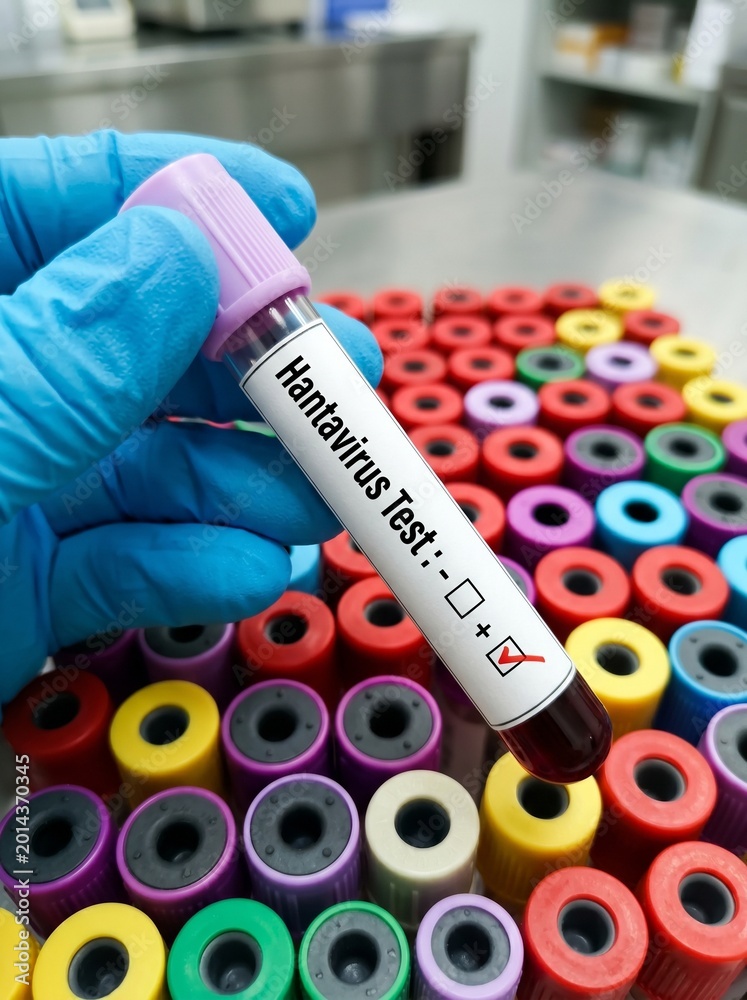 Fototapeta premium Hantavirus Blood Sample Test in Laboratory – Healthcare and Virus Detection shots.