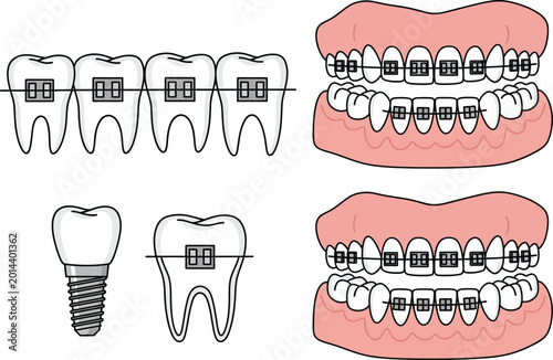 Orthodontic treatment options braces implants and dental health