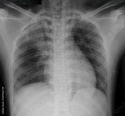 Chest X-ray (CXR) anteroposterior view revealing pneumomediastinum. Free air is visible outlining the mediastinal structures, heart borders, and great vessels.
