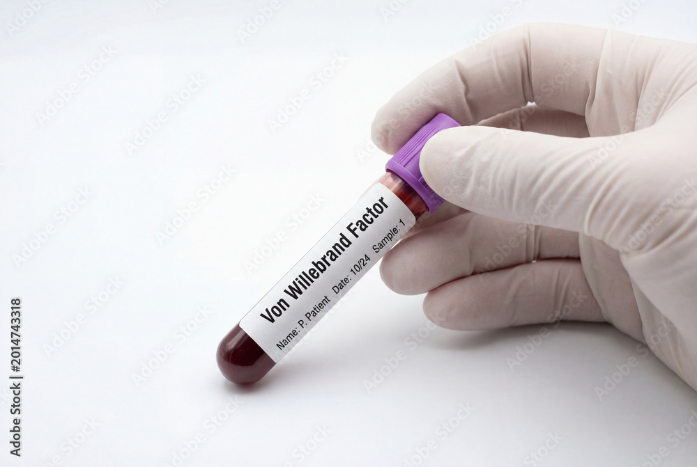 Fototapeta premium Gloved hand holding blood sample tube for von willebrand factor test