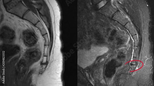 Saggital view coccyx magnetic resonance imaging showing tailbone pain. Detailed radiological scan highlighting coccygeal joint dysfunction and site for therapeutic injection in spinal medicine