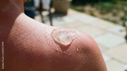 Sunburned skin with soothing gel. Relief from sun damage, UV exposure, and inflammation. Emphasizing dermal health.