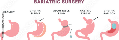 Fotografie "Set of bariatric surgery illustrations showing healthy stomach and types of pro