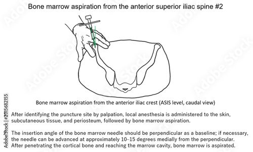 Bild auf Leinwand bone marrow aspiration from the anterior superior iliac spine #2