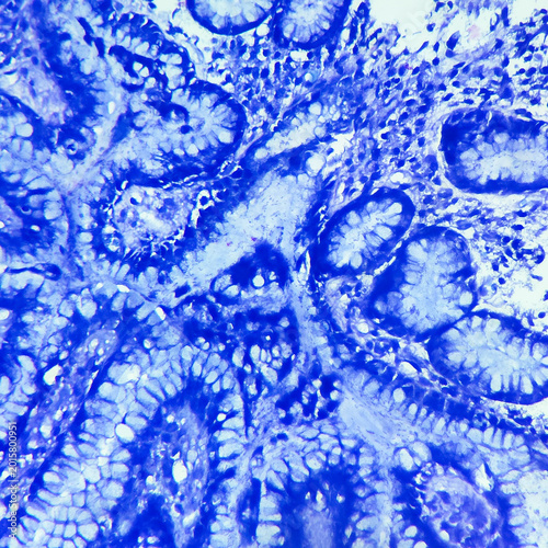 Camera photo of H.pylori associated gastritis, showing curved organisms along foveolar surface in Giemsa stain, magnification 400x, photograph through a microscope