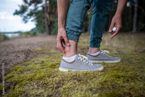 Tableau sur toile Man with mosquitoes bites, itching leg, applying balm or cream on swell skin, suffering from allergic reaction