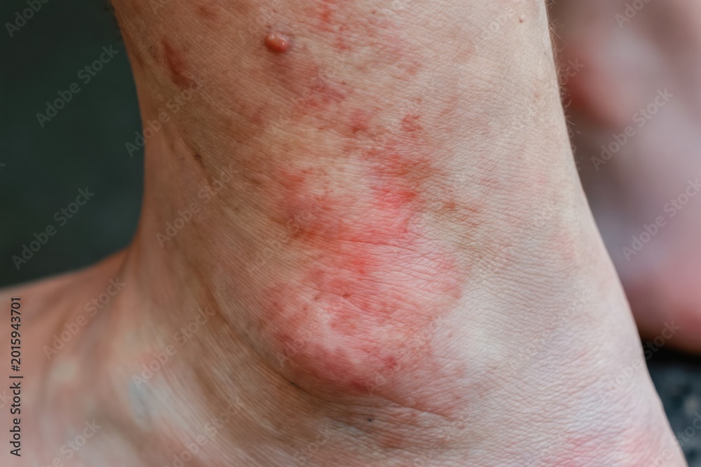 Fototapeta premium Man with red allergic rash on his leg and ankle. Skin shows inflammation and irritation due to eczema or insect bites. Medical condition needs treatment and care.