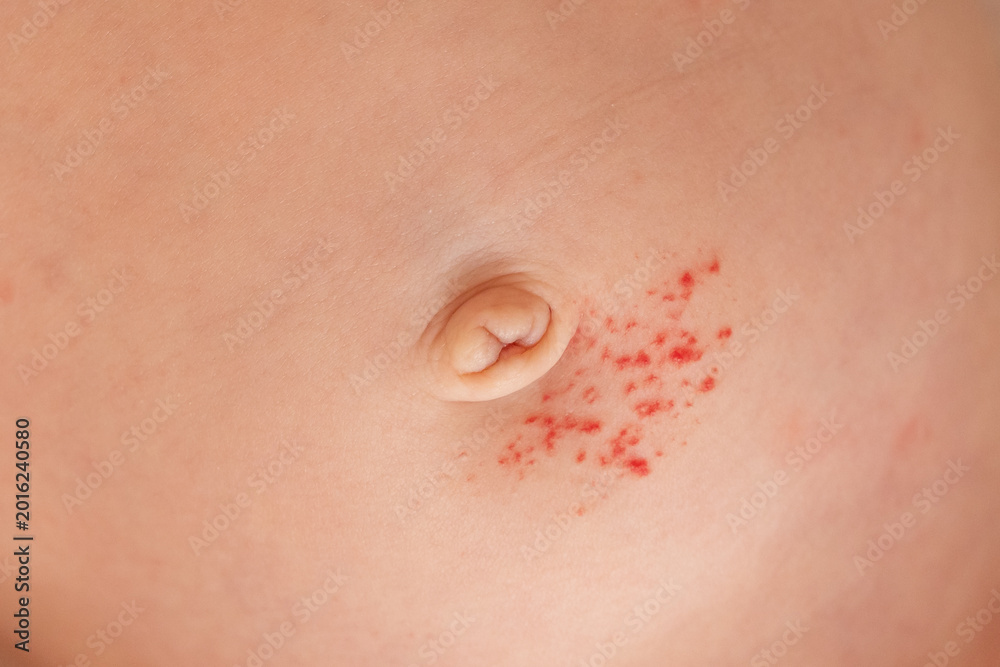Fototapeta premium Close-up of an infant's skin showing a small hemangioma (vascular birthmark) on the body, soft lighting, gentle and clinical feel.