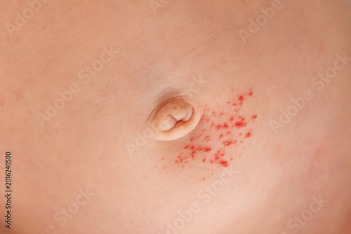 Fotografie Close-up of an infant's skin showing a small hemangioma (vascular birthmark) on the body, soft lighting, gentle and clinical feel