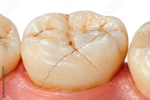 Macro close up of a cracked molar tooth with visible fractures on enamel dental health concept