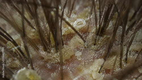 Detailed View of Scalp with Dandruff