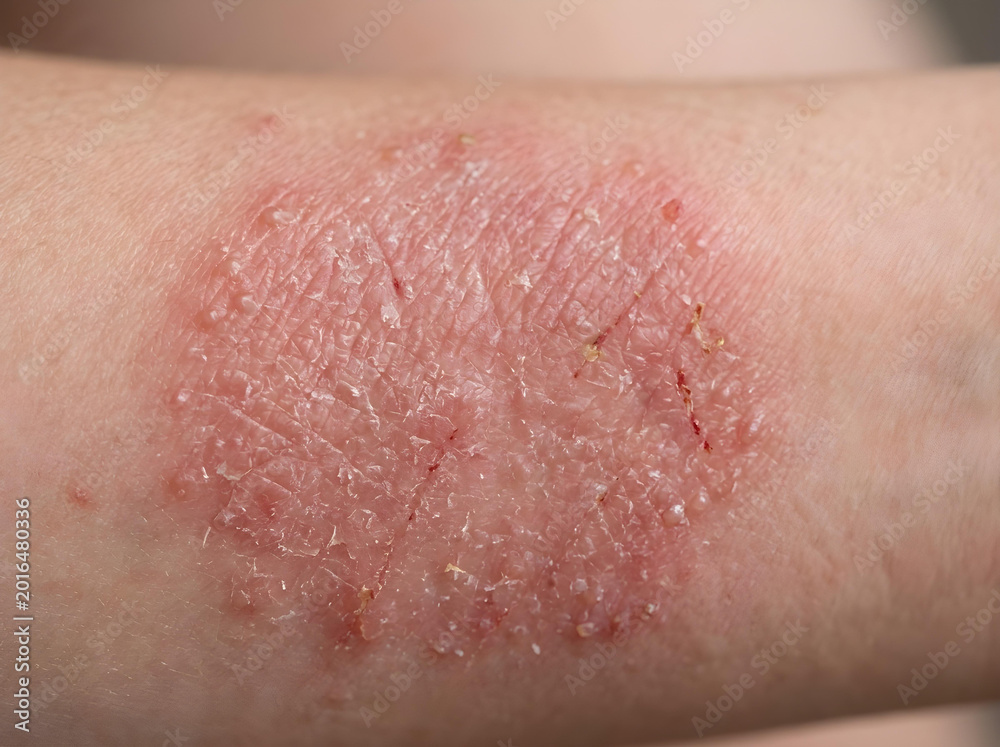 Fototapeta premium close-up of red inflamed skin rash dermatitis on human arm medical condition