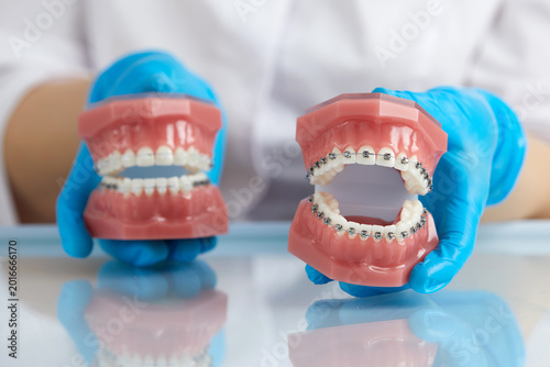 Fotografía Orthodontist showing model of human jaw with wire braces and aligners explaining