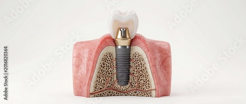 Dental implant cross section with crown and gum anatomy 3D illustration