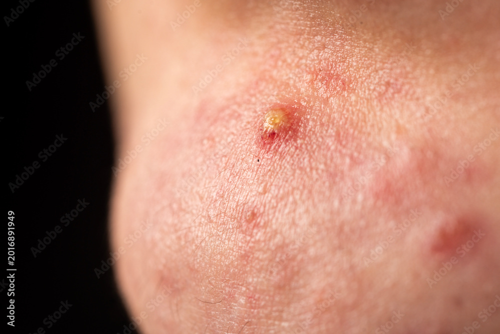 Fototapeta premium Acne skin pimple. Skin problem with pimple bumps. Irritated pimple texture. Close up pimple issue.