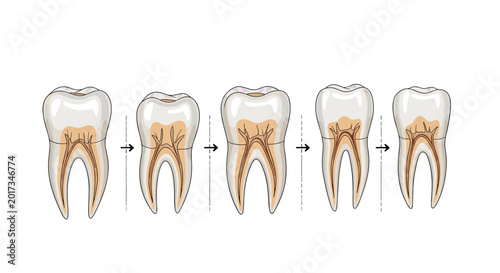Sequential dental diagram showing stages of tooth decay from healthy enamel to deep infection and cavity formation.