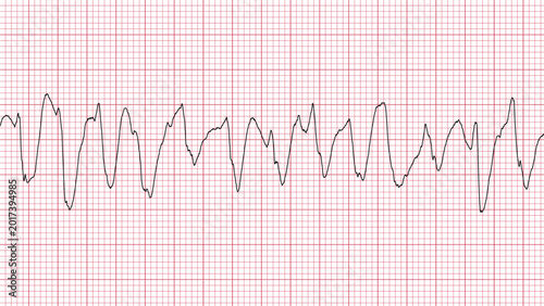 Obraz na płótnie Ventricular Tachycardia Heart Rate ECG Monitor Medical Illustration Graphic Desi