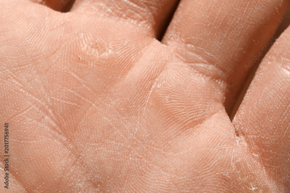 Fototapeta premium Man with dry skin on his hand, closeup