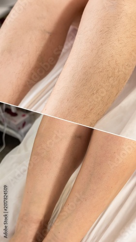 Collage of woman showing leg before and after waxing depilation. Hair Removal epilation procedures result