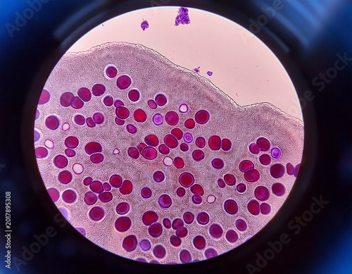 close microscopic analysis of blast cells from acute myeloid leukemia bone marrow aspirate