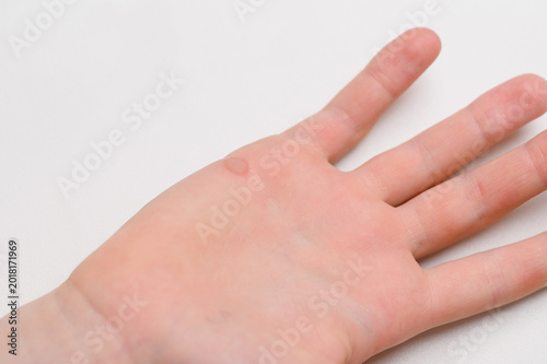 фотографія Common wart on a child's palm close-up