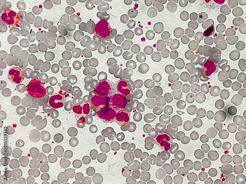 Canvastavla Features suggestive of Chronic Myeloid Leukaemia (Chronic phase)