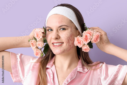 Young woman with acne probl...