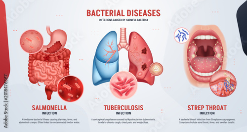 Fotografie Tuberculosis and Salmonella Infection Banner Set