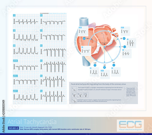 Billede på lærred A 69-year-old male with a clinical diagnosis of COPD