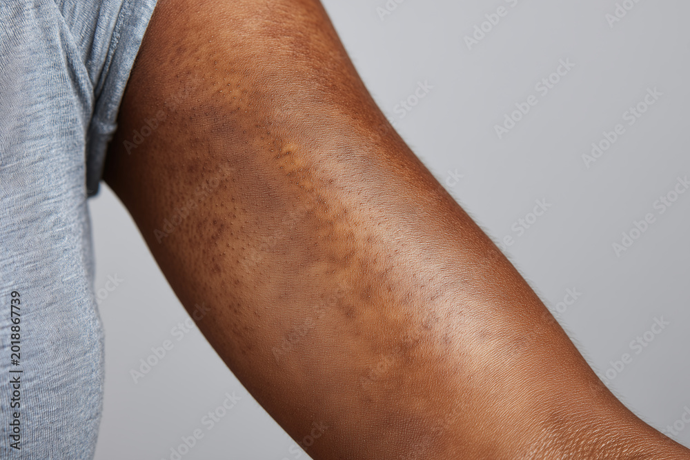Fototapeta premium Close up of dark toned elbow skin with natural texture, visible pores, hair follicles and hyperpigmentation creating realistic dermatology study